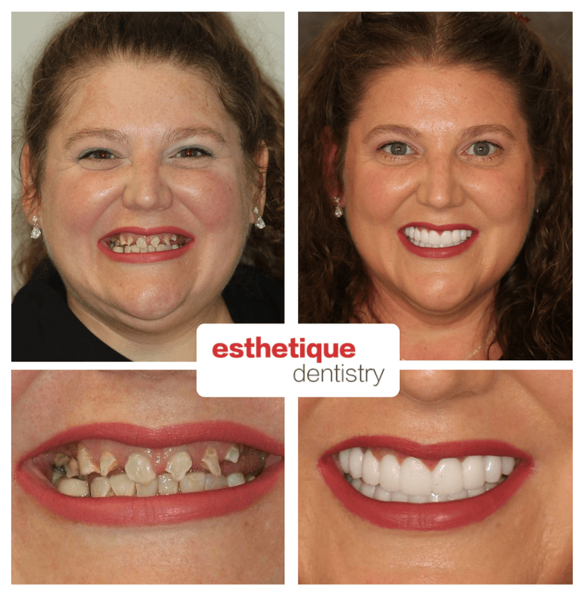 Before and after — Jessica T.