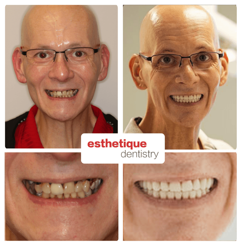 Before and after — Eustachio W.