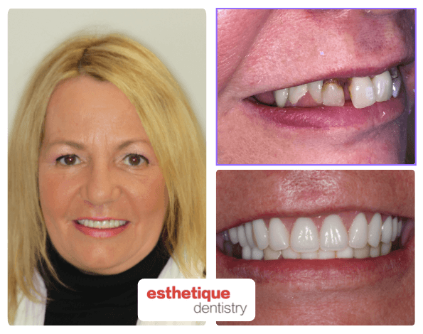 Before and after — Susan W.