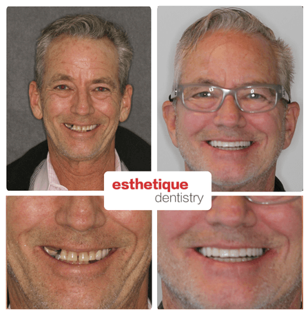 Before and after — Bill K.